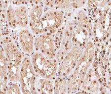 DUSP1 / MKP1 Antibody - 1:200 staining human kidney carcinoma tissue by IHC-P. The tissue was formaldehyde fixed and a heat mediated antigen retrieval step in citrate buffer was performed. The tissue was then blocked and incubated with the antibody for 1.5 hours at 22° C. An HRP conjugated goat anti-rabbit antibody was used as the secondary.