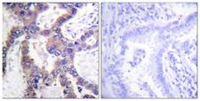 DUSP1 / MKP1 Antibody - Immunohistochemistry analysis of paraffin-embedded human lung carcinoma, using MKP1 (Phospho-Ser359) Antibody. The picture on the right is blocked with the phospho peptide.