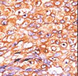 DUSP10 / MKP5 Antibody - Formalin-fixed and paraffin-embedded human cancer tissue reacted with the primary antibody, which was peroxidase-conjugated to the secondary antibody, followed by AEC staining. This data demonstrates the use of this antibody for immunohistochemistry; clinical relevance has not been evaluated. BC = breast carcinoma; HC = hepatocarcinoma.