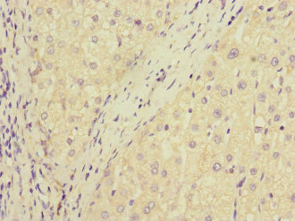 DUSP10 / MKP5 Antibody - Immunohistochemistry of paraffin-embedded human liver cancer at dilution 1:100