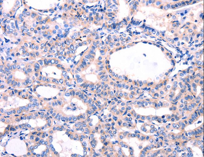 DUSP12 Antibody - Immunohistochemistry of paraffin-embedded Human thyroid cancer using DUSP12 Polyclonal Antibody at dilution of 1:77.