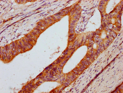 DUSP13 Antibody - IHC image of DUSP13 Antibody diluted at 1:800 and staining in paraffin-embedded human colon cancer performed on a Leica BondTM system. After dewaxing and hydration, antigen retrieval was mediated by high pressure in a citrate buffer (pH 6.0). Section was blocked with 10% normal goat serum 30min at RT. Then primary antibody (1% BSA) was incubated at 4°C overnight. The primary is detected by a biotinylated secondary antibody and visualized using an HRP conjugated SP system.