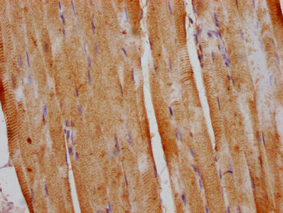 DUSP13 Antibody - IHC image of DUSP13 Antibody diluted at 1:800 and staining in paraffin-embedded human liver cancer performed on a Leica BondTM system. After dewaxing and hydration, antigen retrieval was mediated by high pressure in a citrate buffer (pH 6.0). Section was blocked with 10% normal goat serum 30min at RT. Then primary antibody (1% BSA) was incubated at 4°C overnight. The primary is detected by a biotinylated secondary antibody and visualized using an HRP conjugated SP system.