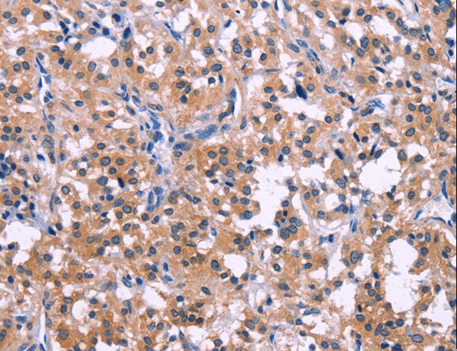 DUSP13 Antibody - Immunohistochemistry of paraffin-embedded Human colon cancer using DUSP13 Polyclonal Antibody at dilution of 1:50.