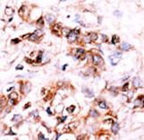 DUSP15 Antibody - Formalin-fixed and paraffin-embedded human cancer tissue reacted with the primary antibody, which was peroxidase-conjugated to the secondary antibody, followed by AEC staining. This data demonstrates the use of this antibody for immunohistochemistry; clinical relevance has not been evaluated. BC = breast carcinoma; HC = hepatocarcinoma.