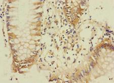 DUSP16 / MKP7 Antibody - Immunohistochemistry of paraffin-embedded human colon cancer at dilution 1:100