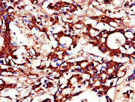 DUSP19 / SKRP1 Antibody - Immunohistochemistry of paraffin-embedded human gastric cancer using DUSP19 Antibody at dilution of 1:100