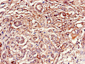 DUSP19 / SKRP1 Antibody - Immunohistochemistry of paraffin-embedded human pancreatic cancer using DUSP19 Antibody at dilution of 1:100