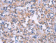 DUSP22 / JSP 1 Antibody - Immunohistochemistry of paraffin-embedded Human thyroid cancer using DUSP22 Polyclonal Antibody at dilution of 1:60.