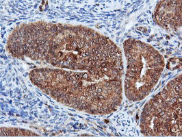 DUSP23 Antibody - IHC of paraffin-embedded Adenocarcinoma of Human endometrium tissue using anti-DUSP23 mouse monoclonal antibody.