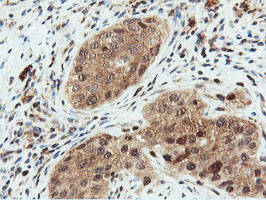 DUSP23 Antibody - IHC of paraffin-embedded Carcinoma of Human bladder tissue using anti-DUSP23 mouse monoclonal antibody.