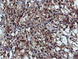 DUSP23 Antibody - IHC of paraffin-embedded Carcinoma of Human kidney tissue using anti-DUSP23 mouse monoclonal antibody.