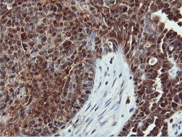 DUSP23 Antibody - IHC of paraffin-embedded Adenocarcinoma of Human ovary tissue using anti-DUSP23 mouse monoclonal antibody.