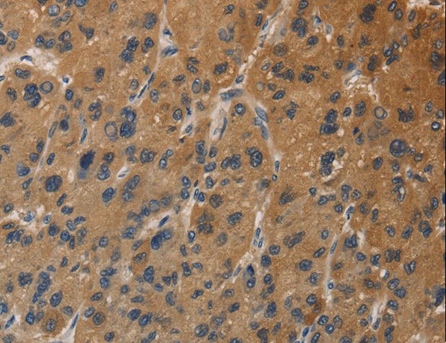 DUSP23 Antibody - Immunohistochemistry of paraffin-embedded Human thyroid cancer using DUSP23 Polyclonal Antibody at dilution of 1:30.
