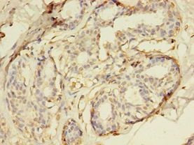 DUSP26 / MKP8 Antibody - Immunohistochemistry of paraffin-embedded human breast cancer using antibody at 1:100 dilution.  This image was taken for the unconjugated form of this product. Other forms have not been tested.