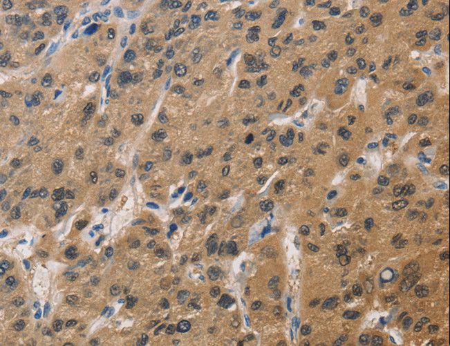 DUSP26 / MKP8 Antibody - Immunohistochemistry of paraffin-embedded Human thyroid cancer using DUSP26 Polyclonal Antibody at dilution of 1:60.