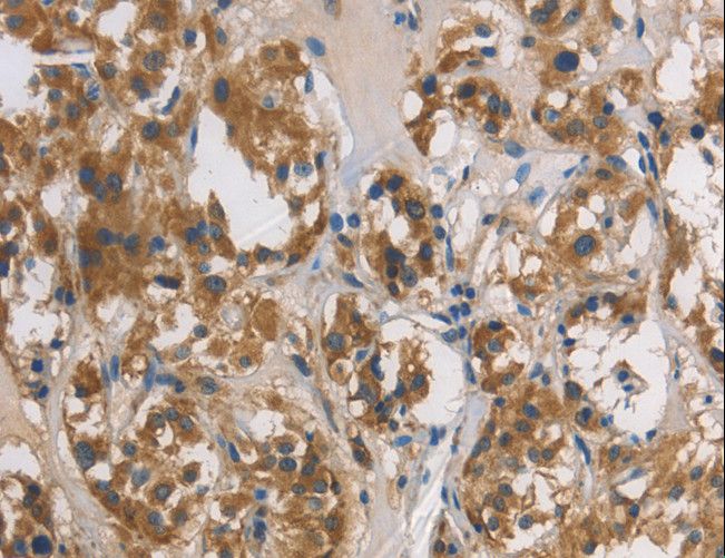 DUSP26 / MKP8 Antibody - Immunohistochemistry of paraffin-embedded Human thyroid cancer using DUSP26 Polyclonal Antibody at dilution of 1:60.