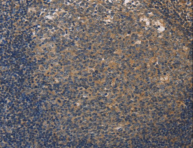 DUSP26 / MKP8 Antibody - Immunohistochemistry of paraffin-embedded Human liver cancer using DUSP26 Polyclonal Antibody at dilution of 1:50.
