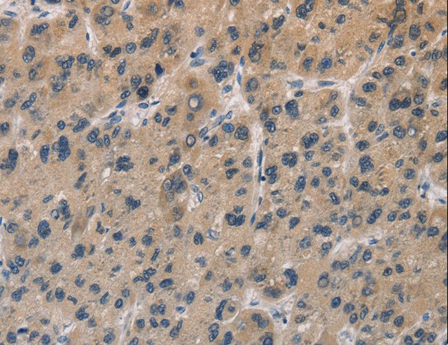 DUSP26 / MKP8 Antibody - Immunohistochemistry of paraffin-embedded Human liver cancer using DUSP26 Polyclonal Antibody at dilution of 1:50.