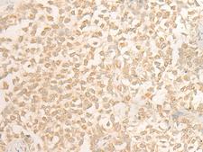 DUSP27 Antibody - Immunohistochemistry of paraffin-embedded Human ovarian cancer tissue  using DUSP27 Polyclonal Antibody at dilution of 1:50(×200)