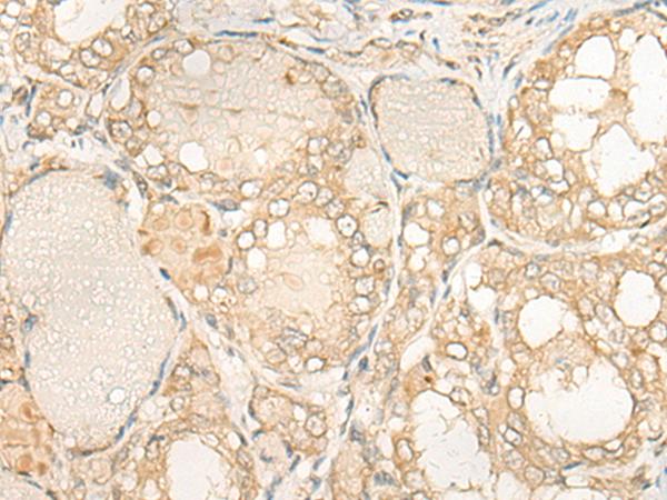 DUSP27 Antibody - Immunohistochemistry of paraffin-embedded Human thyroid cancer tissue  using DUSP27 Polyclonal Antibody at dilution of 1:50(×200)