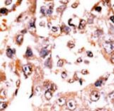 DUSP3 / VHR Antibody - Formalin-fixed and paraffin-embedded human cancer tissue reacted with the primary antibody, which was peroxidase-conjugated to the secondary antibody, followed by AEC staining. This data demonstrates the use of this antibody for immunohistochemistry; clinical relevance has not been evaluated. BC = breast carcinoma; HC = hepatocarcinoma.