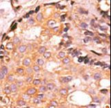 DUSP4 / MKP2 Antibody - Formalin-fixed and paraffin-embedded human cancer tissue reacted with the primary antibody, which was peroxidase-conjugated to the secondary antibody, followed by AEC staining. This data demonstrates the use of this antibody for immunohistochemistry; clinical relevance has not been evaluated. BC = breast carcinoma; HC = hepatocarcinoma.