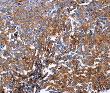 DUSP6 / MKP3 Antibody - Immunohistochemistry of paraffin-embedded human ovarian cancer tissue.
