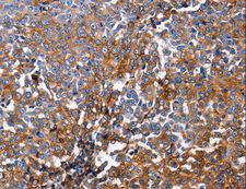 DUSP6 / MKP3 Antibody - Immunohistochemistry of paraffin-embedded Human ovarian cancer using DUSP6 Polyclonal Antibody at dilution of 1:25.