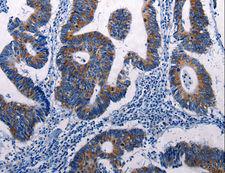 DUSP6 / MKP3 Antibody - Immunohistochemistry of paraffin-embedded Human colon cancer using DUSP6 Polyclonal Antibody at dilution of 1:50.