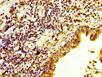 DUSP6 / MKP3 Antibody - Immunohistochemistry image at a dilution of 1:200 and staining in paraffin-embedded human lung cancer performed on a Leica BondTM system. After dewaxing and hydration, antigen retrieval was mediated by high pressure in a citrate buffer (pH 6.0) . Section was blocked with 10% normal goat serum 30min at RT. Then primary antibody (1% BSA) was incubated at 4 °C overnight. The primary is detected by a biotinylated secondary antibody and visualized using an HRP conjugated SP system.