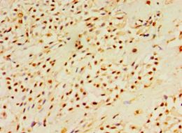 DUSP7 Antibody - Immunohistochemistry of paraffin-embedded human breast cancer using antibody at 1:100 dilution.