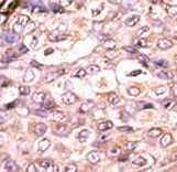 DUSP7 Antibody - Formalin-fixed and paraffin-embedded human cancer tissue reacted with the primary antibody, which was peroxidase-conjugated to the secondary antibody, followed by AEC staining. This data demonstrates the use of this antibody for immunohistochemistry; clinical relevance has not been evaluated. BC = breast carcinoma; HC = hepatocarcinoma.