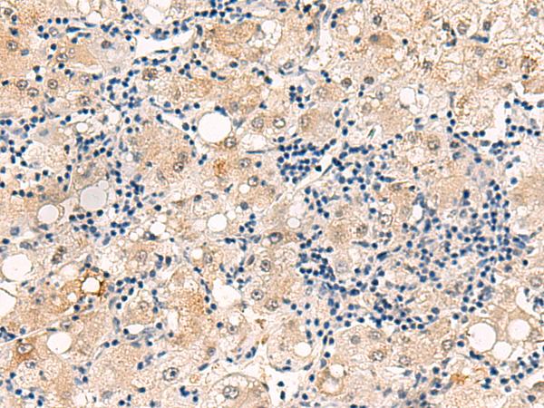 DUSP7 Antibody - Immunohistochemistry of paraffin-embedded Human liver cancer tissue  using DUSP7 Polyclonal Antibody at dilution of 1:50(×200)