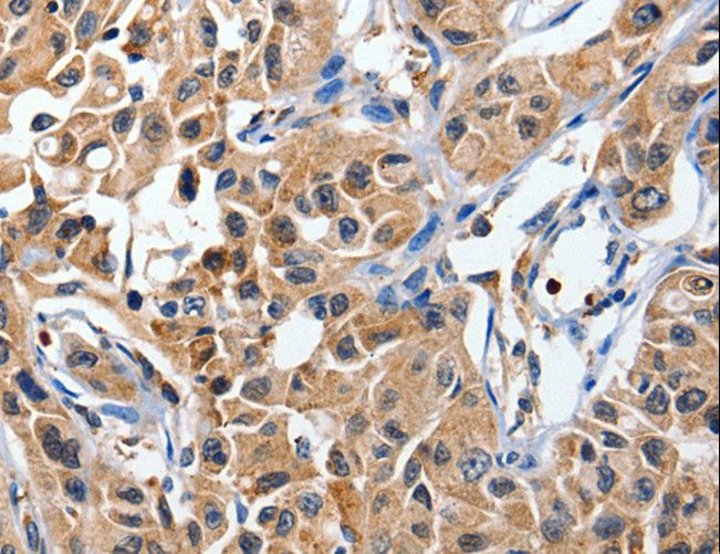 DUSP8 Antibody - Immunohistochemistry of paraffin-embedded Human lung cancer using DUSP8 Polyclonal Antibody at dilution of 1:40.