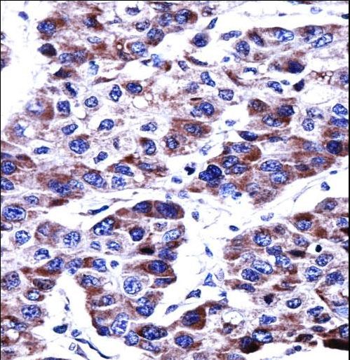 DUSP9 Antibody - DUSP9 Antibody immunohistochemistry of formalin-fixed and paraffin-embedded human hepatocarcinoma followed by peroxidase-conjugated secondary antibody and DAB staining.