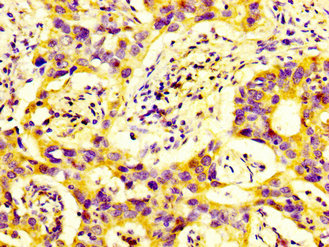 DUSP9 Antibody - Immunohistochemistry image at a dilution of 1:600 and staining in paraffin-embedded human bladder cancer performed on a Leica BondTM system. After dewaxing and hydration, antigen retrieval was mediated by high pressure in a citrate buffer (pH 6.0) . Section was blocked with 10% normal goat serum 30min at RT. Then primary antibody (1% BSA) was incubated at 4 °C overnight. The primary is detected by a biotinylated secondary antibody and visualized using an HRP conjugated SP system.