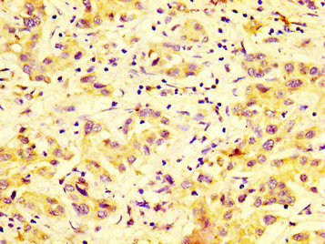 DUSP9 Antibody - Immunohistochemistry image at a dilution of 1:600 and staining in paraffin-embedded human liver cancer performed on a Leica BondTM system. After dewaxing and hydration, antigen retrieval was mediated by high pressure in a citrate buffer (pH 6.0) . Section was blocked with 10% normal goat serum 30min at RT. Then primary antibody (1% BSA) was incubated at 4 °C overnight. The primary is detected by a biotinylated secondary antibody and visualized using an HRP conjugated SP system.