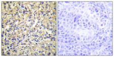 DUSP9 Antibody - Peptide - + Immunohistochemistry analysis of paraffin-embedded human liver carcinoma tissue using DUSP9 antibody.