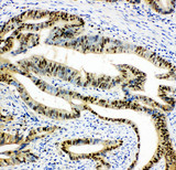 DUT / DUTPase Antibody - DUT / DUTPase antibody. IHC(P): Human Intestinal Cancer Tissue.