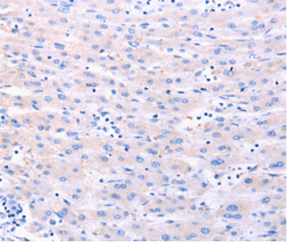 DUT / DUTPase Antibody - Immunohistochemistry of paraffin-embedded human liver cancer tissue using DUT antibody.