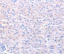 DUT / DUTPase Antibody - Immunohistochemistry of paraffin-embedded human liver cancer tissue using DUT antibody.