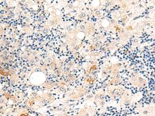 DUT / DUTPase Antibody - Immunohistochemistry of paraffin-embedded Human liver cancer tissue  using DUT Polyclonal Antibody at dilution of 1:60(×200)