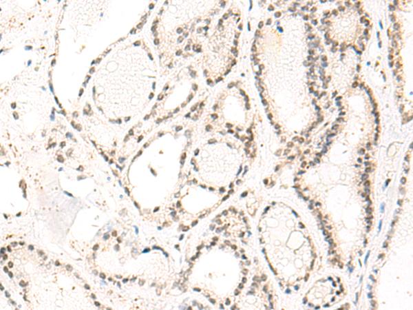 DUT / DUTPase Antibody - Immunohistochemistry of paraffin-embedded Human thyroid cancer tissue  using DUT Polyclonal Antibody at dilution of 1:60(×200)