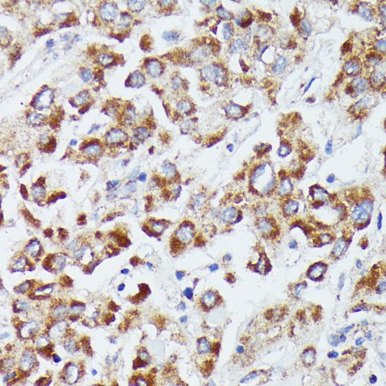 DUT / DUTPase Antibody - Immunohistochemistry of paraffin-embedded Human liver cancer using DUT Polyclonal Antibody at dilution of 1:100 (40x lens).
