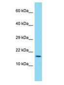DUX1 Antibody - DUX1 antibody Western Blot of Esophagus Tumor. Antibody dilution: 1 ug/ml.  This image was taken for the unconjugated form of this product. Other forms have not been tested.