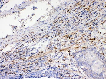 DVL1 / DVL / Dishevelled Antibody - IHC testing of FFPE human lung cancer tissue with DVL1 antibody at 1ug/ml. Required HIER: steam section in pH6 citrate buffer for 20 min and allow to cool prior to testing.