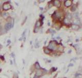 DVL1 / DVL / Dishevelled Antibody - Immunohistochemistry of paraffin-embedded human breast cancer tissue slide using DVL1 antibody at dilution of 1:200