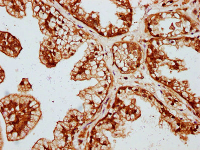 DVL2 / Dishevelled 2 Antibody - IHC image of DVL2 Antibody diluted at 1:227 and staining in paraffin-embedded human prostate cancer performed on a Leica BondTM system. After dewaxing and hydration, antigen retrieval was mediated by high pressure in a citrate buffer (pH 6.0). Section was blocked with 10% normal goat serum 30min at RT. Then primary antibody (1% BSA) was incubated at 4°C overnight. The primary is detected by a biotinylated secondary antibody and visualized using an HRP conjugated SP system.