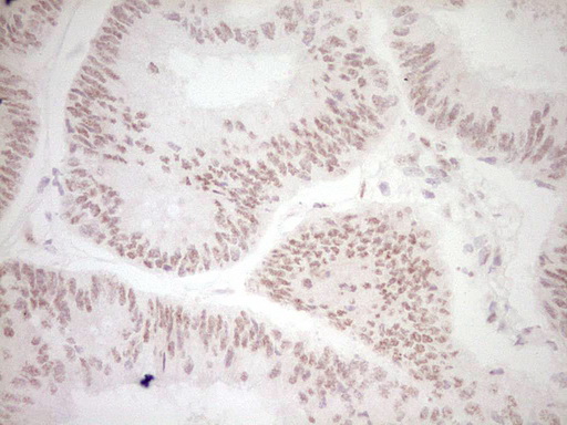 DVL2 / Dishevelled 2 Antibody - Immunohistochemical staining of paraffin-embedded Adenocarcinoma of Human colon tissue using anti-DVL2 mouse monoclonal antibody. (Heat-induced epitope retrieval by 1 mM EDTA in 10mM Tris, pH8.5, 120C for 3min,
